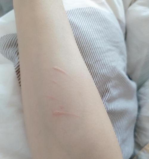 宠物猫咪咬伤后应该去哪里打针（了解猫咪咬伤的处理方法）